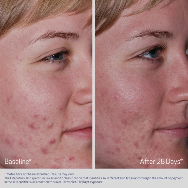 Obagi CLENZIderm M.D.® Acne Therapeutic System - Image 5