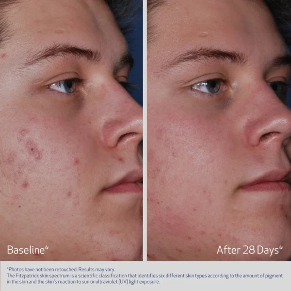 Obagi CLENZIderm M.D.® Acne Therapeutic System - Image 6